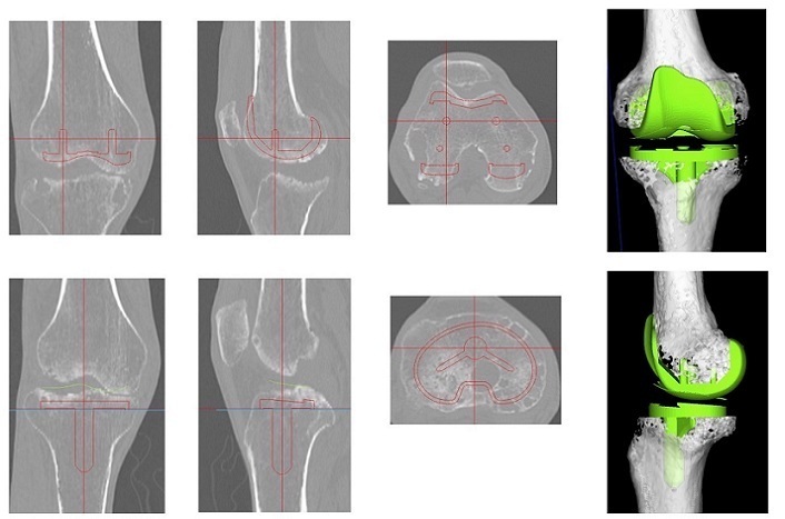 三次元CTによる術前計画（膝関節）