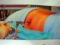PELD（経皮的内視鏡下椎間板摘出術）の様子1