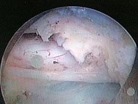 PELD（経皮的内視鏡下椎間板摘出術）の様子2