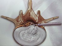 PELD（経皮的内視鏡下椎間板摘出術）の断面図