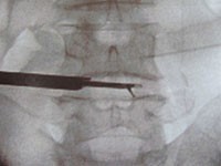 PELD（経皮的内視鏡下椎間板摘出術）の様子3