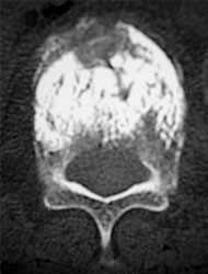椎体形成術のレントゲン画像1