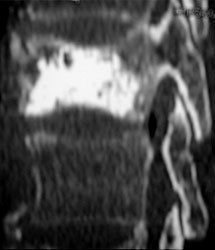 椎体形成術のレントゲン画像2