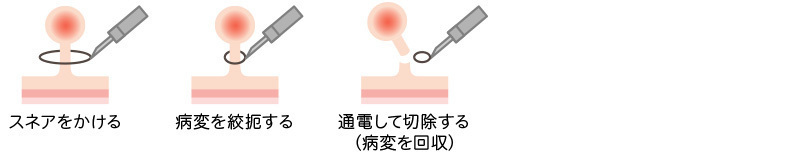 ポリペクトミーの図。1.スネアをかける、2病変を絞扼する、3通電して切除する（病変を回収）