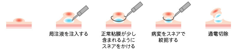 EMRの図。1.局注液を注入する、2.正常粘膜が少し含まれるようにスネアをかける、3.病変をスネアで絞扼する、4.通電切除